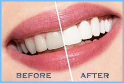 tooth-whitening